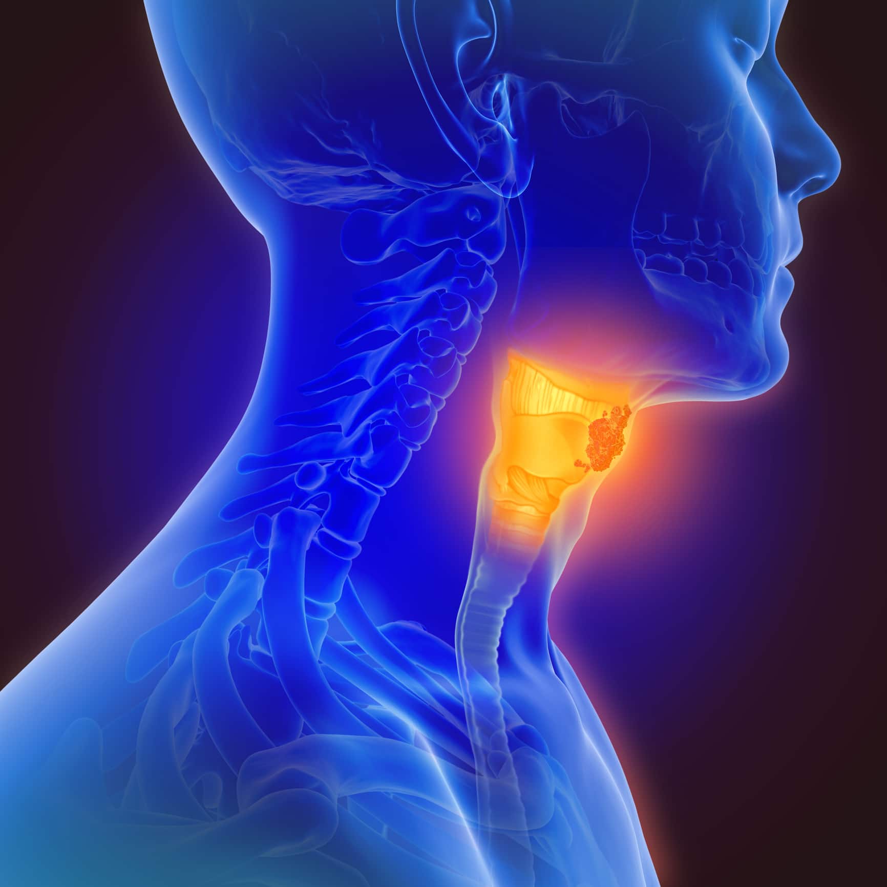 Head and Neck Cancer Image
